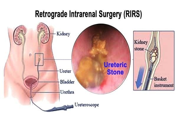 Retrograde Intrareal Surgery(RIRS)