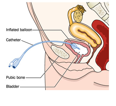 Uretheral Stricture treatment in Aundh