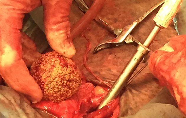 Bladder stone treatment in Aund