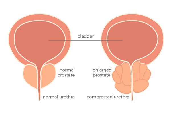 Bladder Surgery: Bladder Stone, TURBT