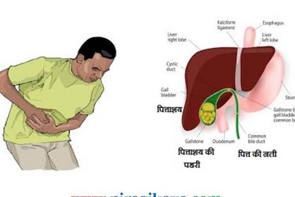 Bladder Stone