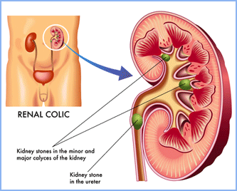 Hypospadius / Hernia / Hydrocoele