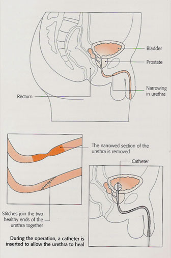 Uretheral Stricture treatment in Aundh