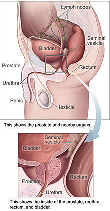 Prostate Cancer Treatment in Aundh,Pune