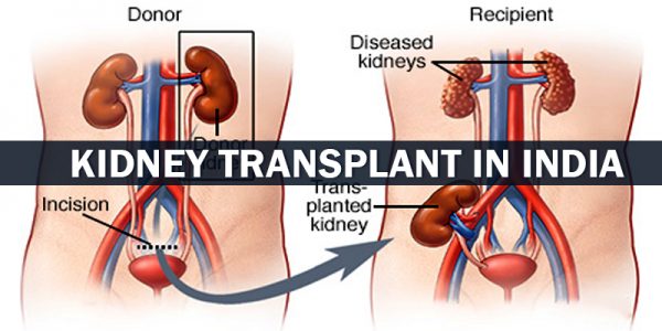 Kidney Transplant