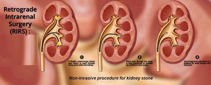 Retrograde Intrarenal Surgery (RIRS)