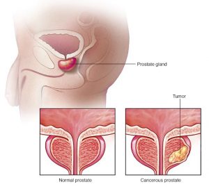 Prostate cancer treatment in Aundh