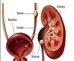 Urologist In Aundh