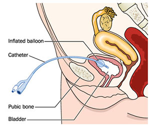 Uretheral Stricture treatment in Aundh