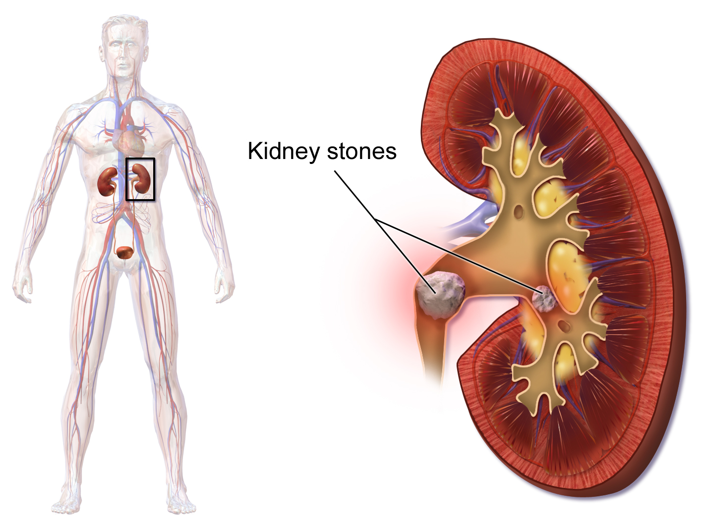 Kidney Stone Treatment | Kidney stone specialist in Aundh