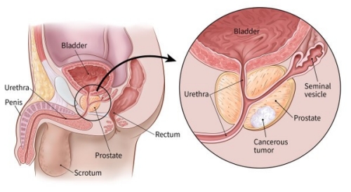 Prostate Cancer Treatment in S B Road