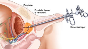 Prostate Cancer Treatment in Shivaji Nagar,Pune