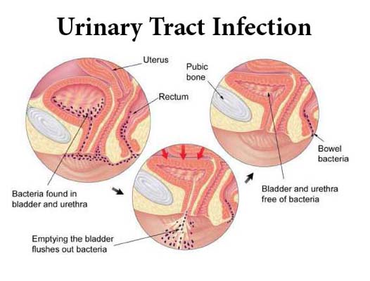 Urinary tract infection treatment in Pune