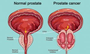 Prostate Cancer Treatment in S B Road