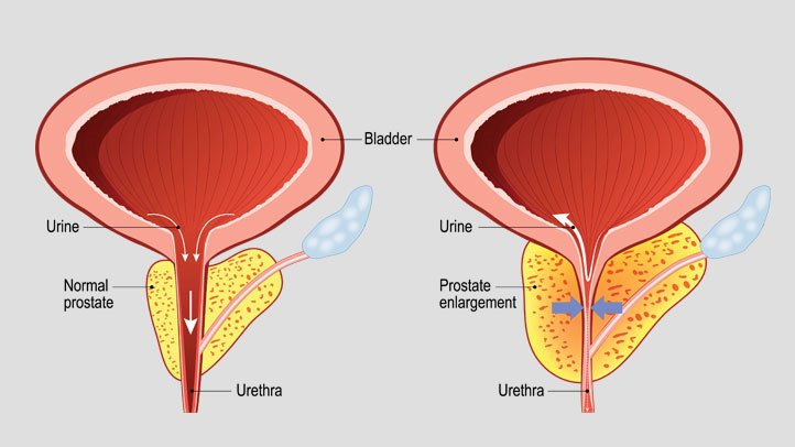 Prostate Cancer Treatment in Shivaji Nagar,Pune