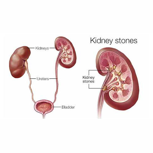 Kidney stone treatment in SB road, Kidney stone specialist in SB road.