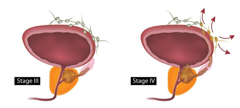 Further growth and spread of prostate cancer