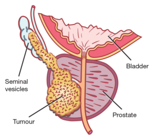 Localized prostate cancer_Dr Hiralal Chaudhari