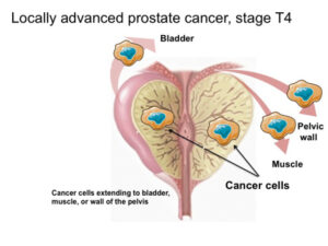 Locally advanced prostate cancer_Dr Hiralal Chaudhari