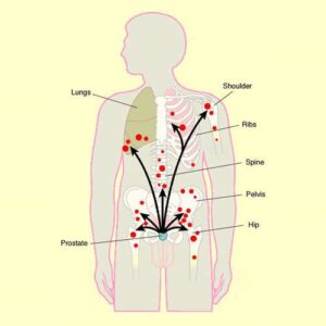 Metastatic prostate cancer_Dr Hiralal Chaudhari